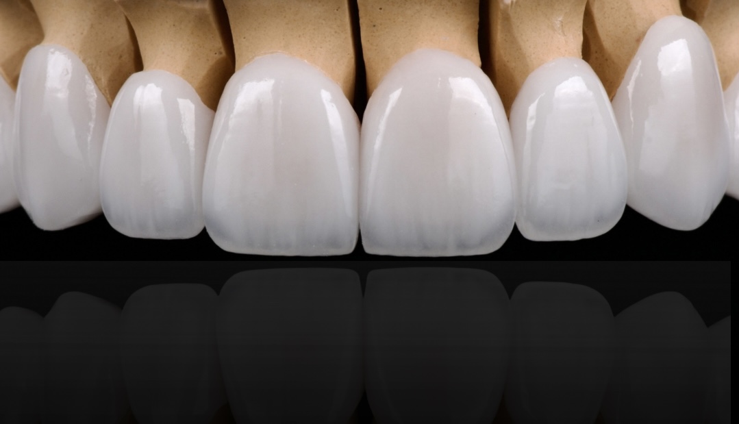 Aesthetic Veneers